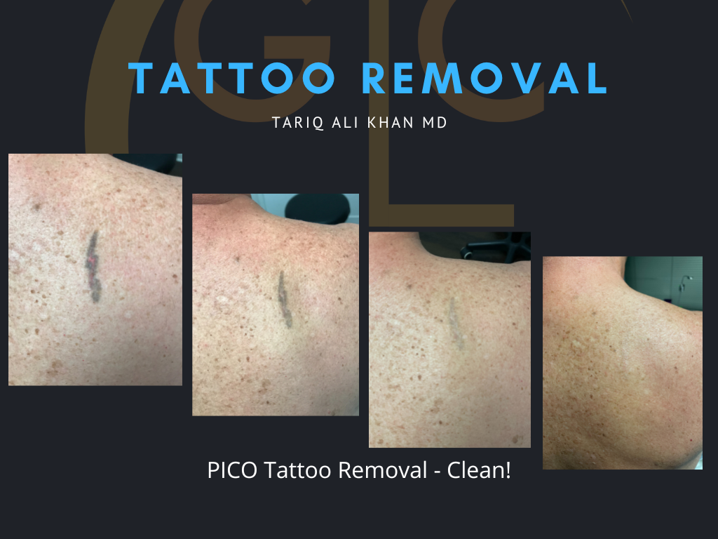 Gentle Care Laser Tustin & Long Beach Before and After picture - Tattoo Removal Mucosal Surface